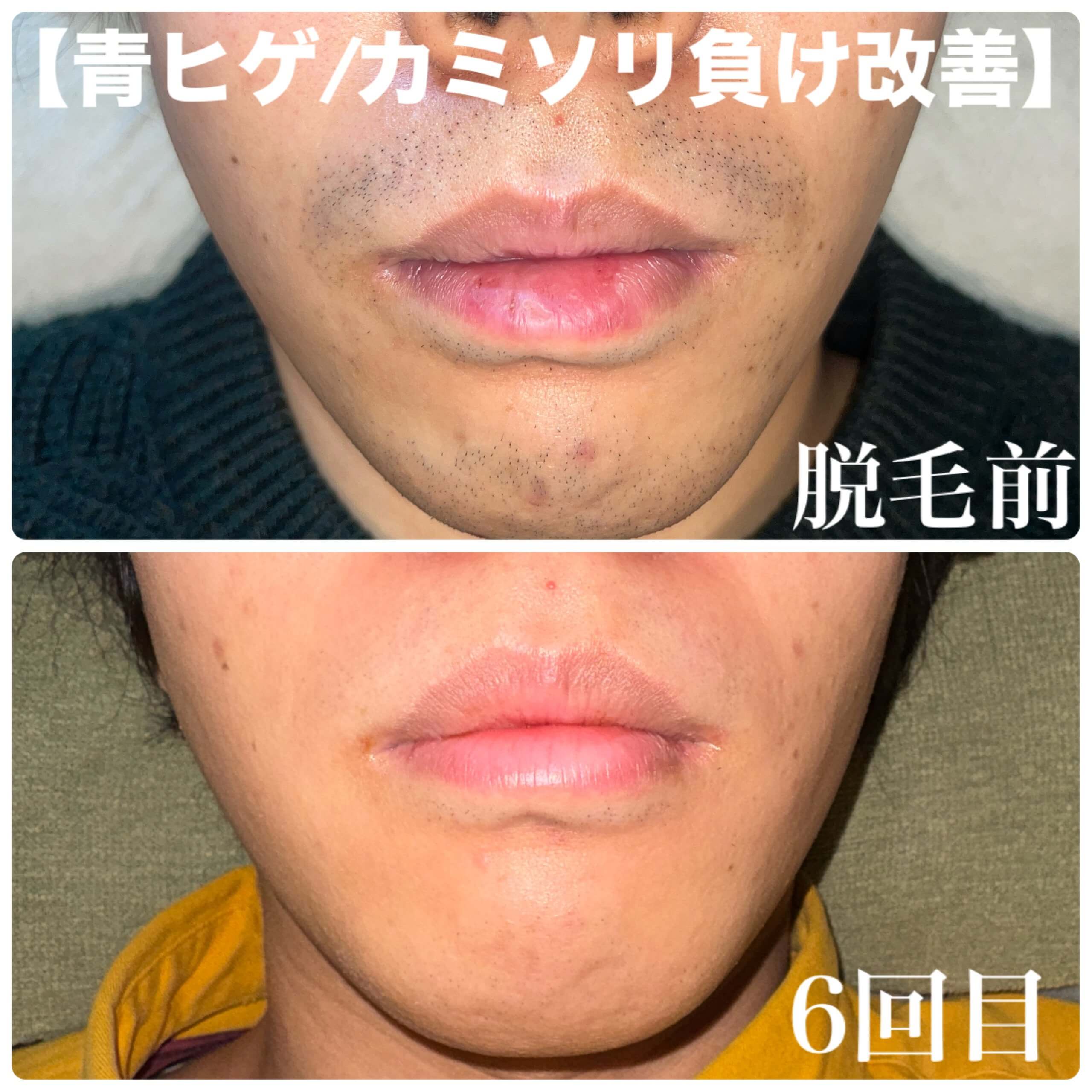 施術前後を並べた比較写真